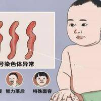 有人说说21染色体异常婴儿出生后的照片是什么样的吗？