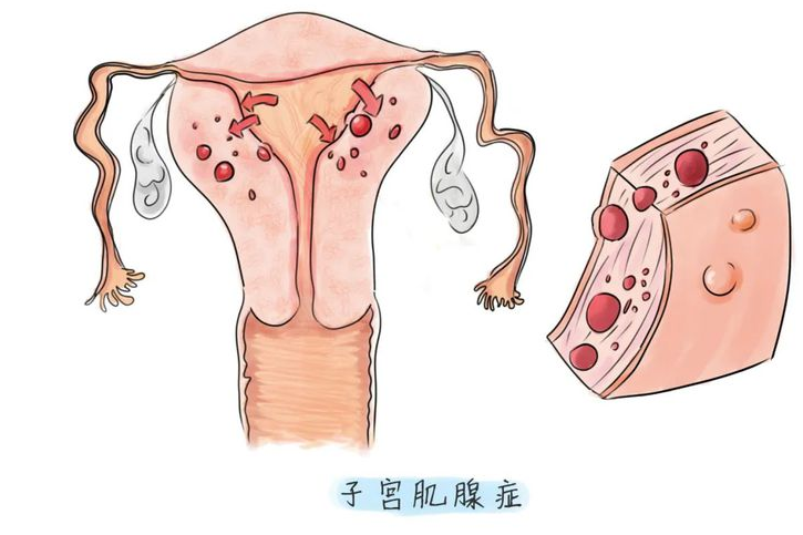 子宫腺肌症最怕三种运动，治疗子宫腺肌症的最佳方法！