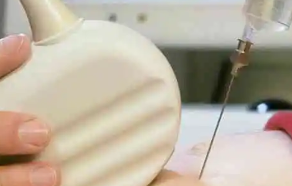 羊水穿刺能检测胎儿染色体异常