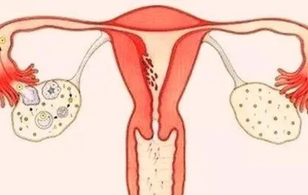 双侧卵巢没有卵泡通过药物治疗可能治得好
