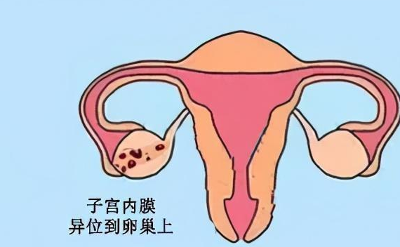 子宫内膜异位症是妇科疾病