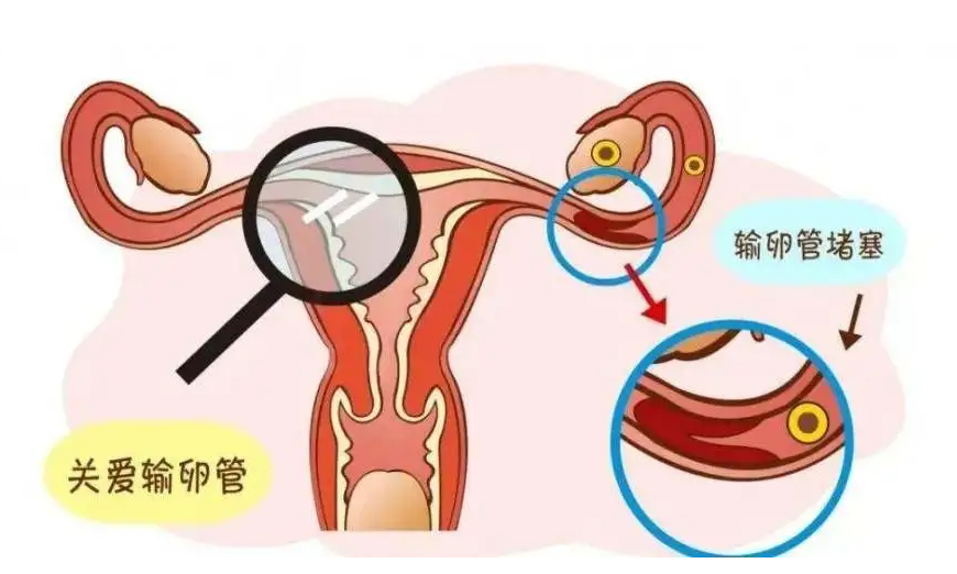 一侧输卵管通畅有备孕成功的吗？一侧输卵管不通畅会怎么样