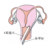 B超看到多少卵，就能取到多少卵吗？