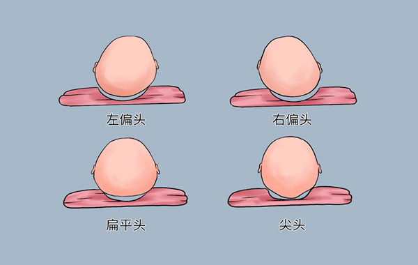 让新生儿左右交替睡觉改善偏头