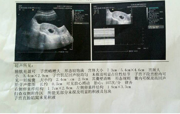 孕囊位置偏低会影响胎儿发育