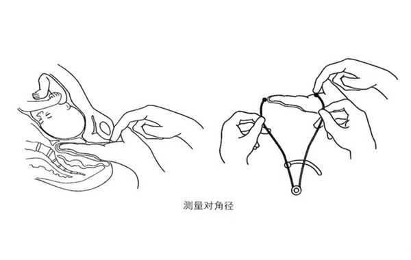 对角径测量正常为12.5-13cm