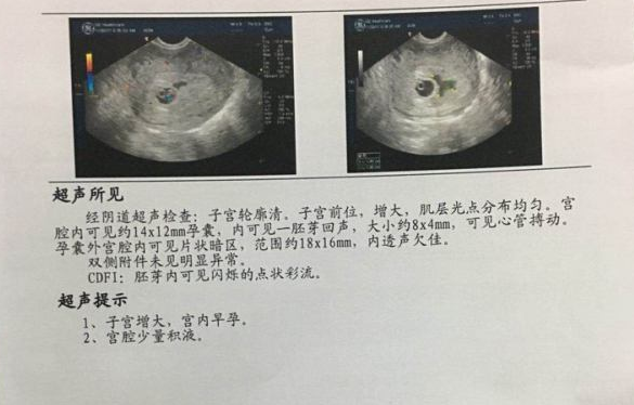 孕囊超声检查报告