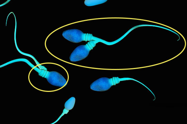 精子头部缺陷会导致受孕困难
