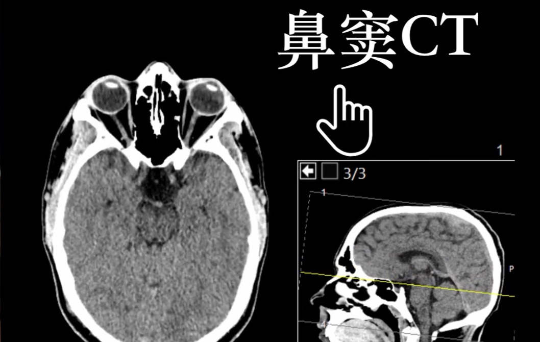 鼻窦CT容易导致孩子消化道异常