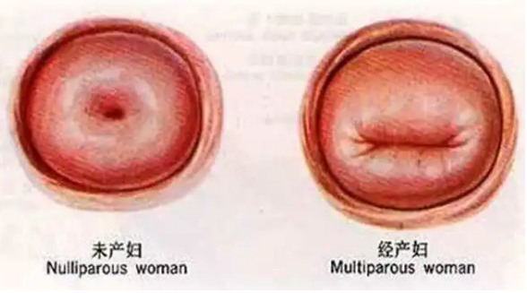 生了孩子的宫颈口呈横列状态