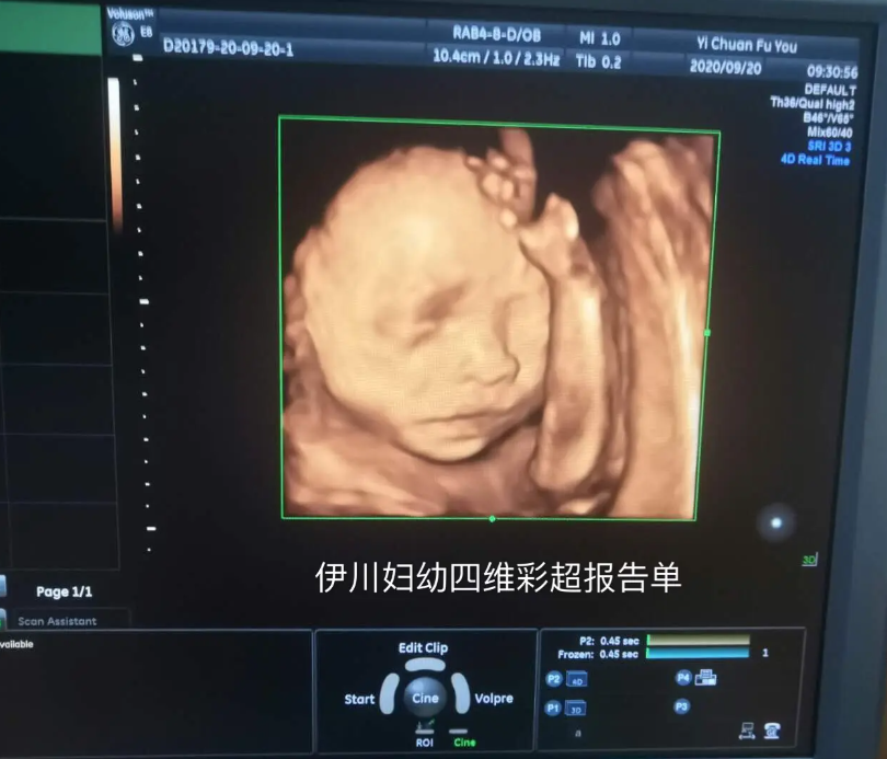 胎儿体位的关系会导致四维检查性别翻盘