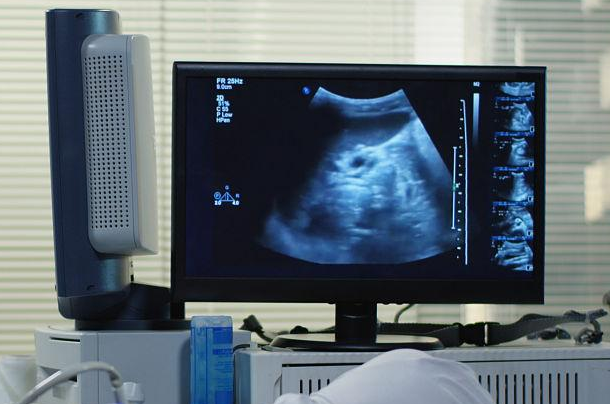 超声波观察到孕囊表示怀孕