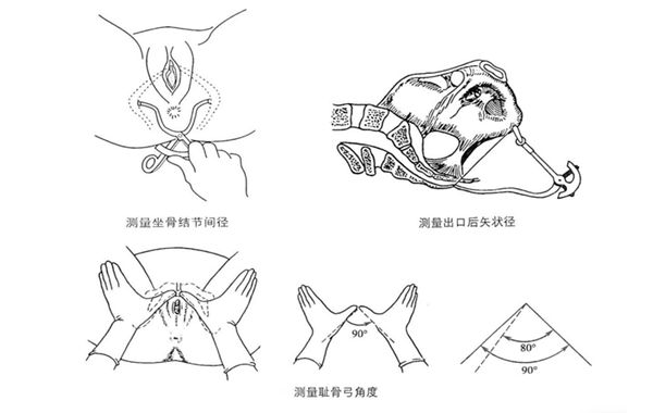 坐骨结节间径和出口后矢状径测量图