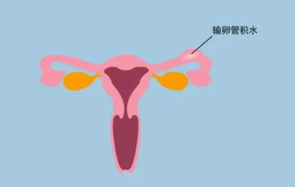 输卵管积水中含有大量的细菌和病毒