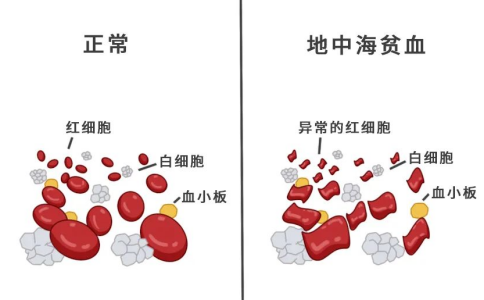 什么是地中海贫血？地贫一般遗传爸爸还是妈妈的