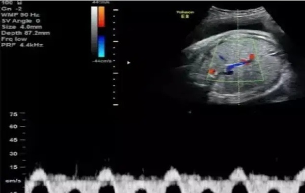 子宫动脉阻力24周以后就不用看了