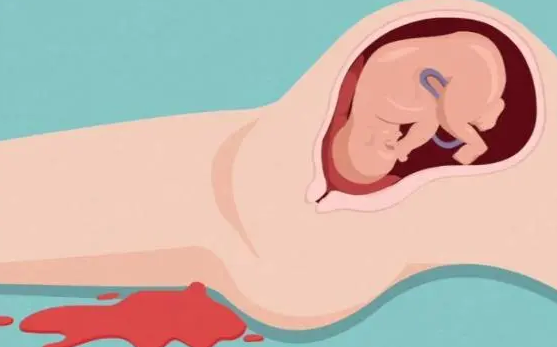 胚胎质量不佳是导致流产的原因