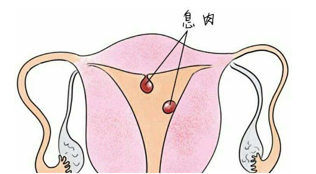 子宫息肉是什么原因引起的？术后有哪些注意事项？