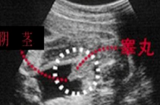 胎儿的姿势会影响B超判断胎儿男女