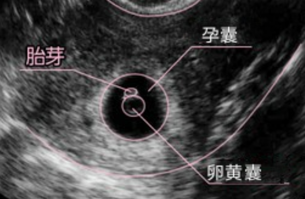 怀孕六周胎芽有5mm大