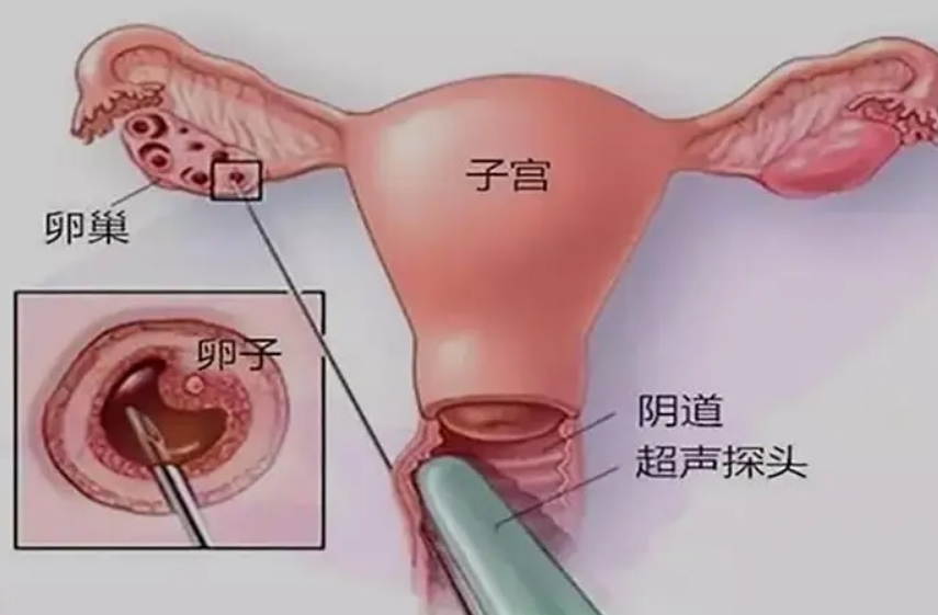 取卵手术的目的是采集女性患者的卵子