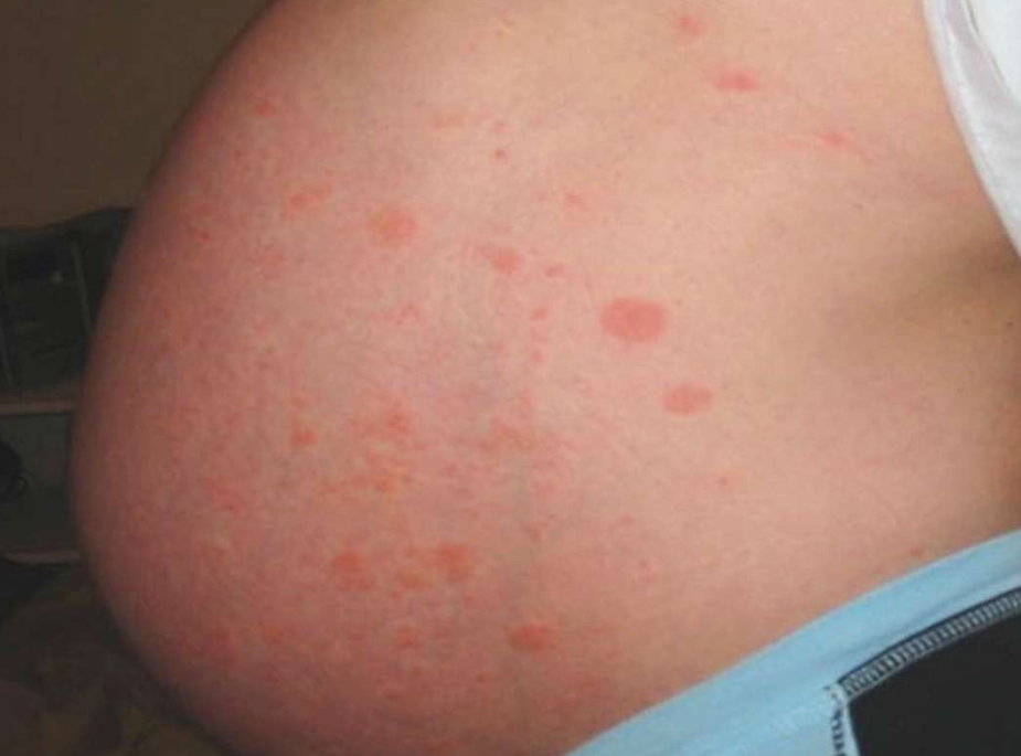 怀孕期间得了荨麻疹全身瘙痒对宝宝有影响吗？