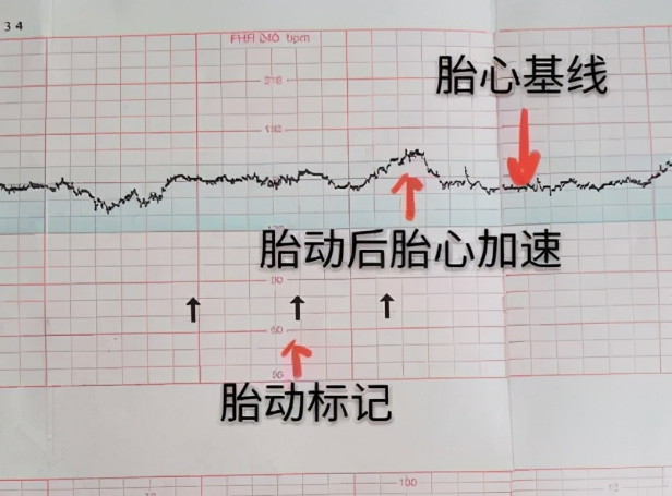 母体的位置会影响胎心率的高低