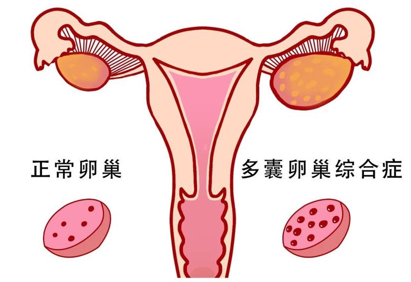 多囊卵巢拖久了会怎样？怎么调理才能好？