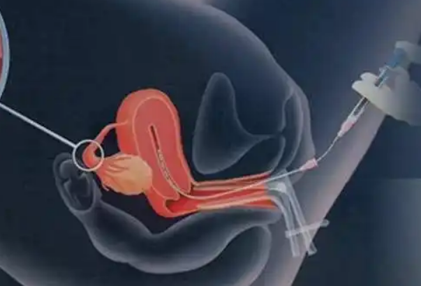 人工授精可以提供受孕几率