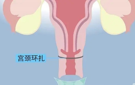 宫颈环扎后不一定要卧床躺到生