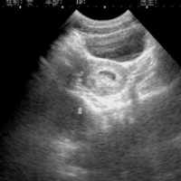 移植第六天的囊胚后一个月b超检查没见胎芽正常吗？