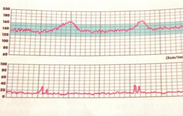 胎心监护合格的标准图有两条曲线
