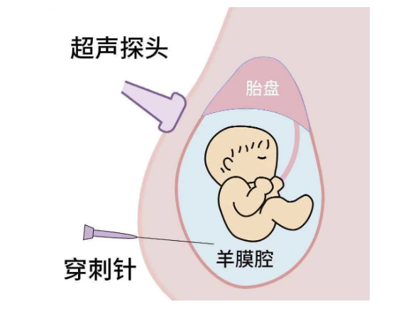 孕妈在孕期做了羊水穿刺仍有生下畸形儿的风险