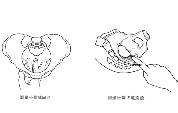 坐骨棘间径和坐骨切迹宽度测量图
