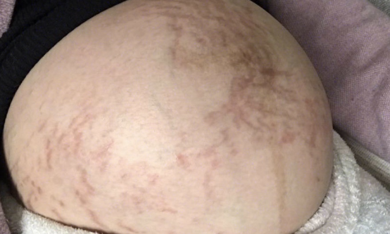 妊娠纹的形成与孕期皮肤过度拉伸有关