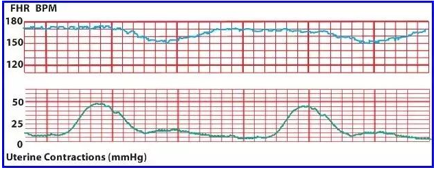 怀孕38周不正常胎心监护参照图