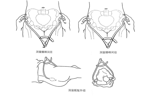 骼嵴间径和骶耻外径测量图