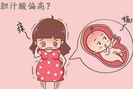 孕期总胆汁酸高