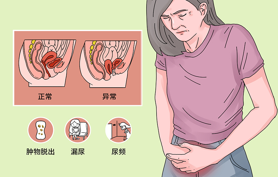 阴壁膨出短期不能自行恢复