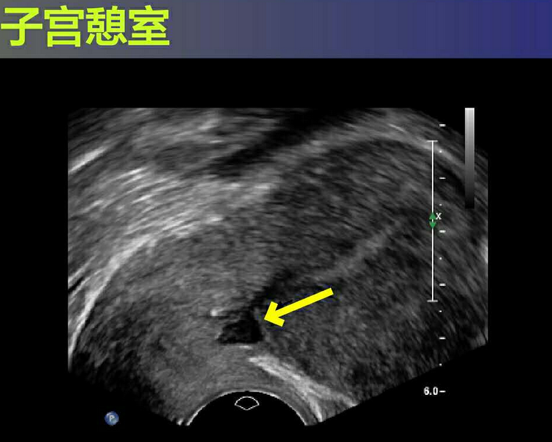 子宫憩室对生育影响