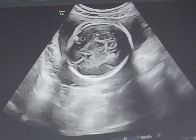 B超可以预测胎儿是男是女