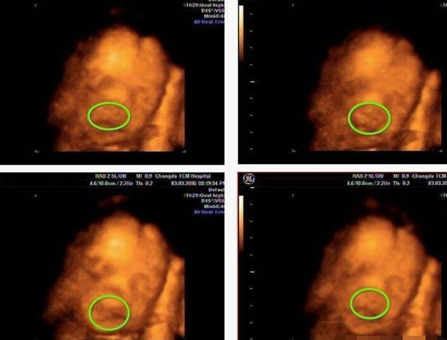 四维彩超可发现胎儿头围异常