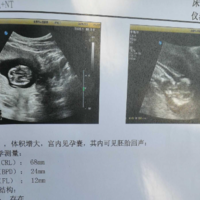 已生男宝的nt单子心率是多少，附已生男宝的nt单子心率图片