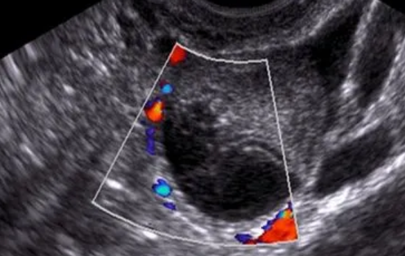 女性去医院检查出卵巢畸胎瘤