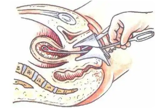 子宫取环全过程是怎样的？取环后要注意那些？