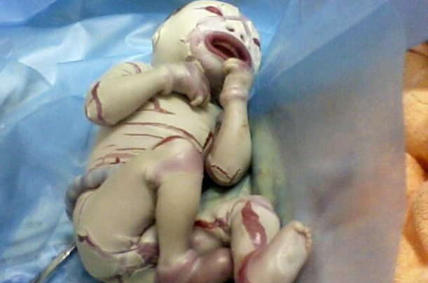 遗传病会导致火棉胶婴儿出生