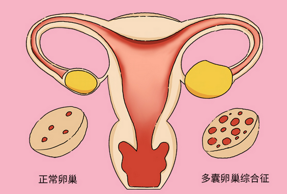 多囊卵巢综合症导致不孕