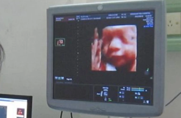 孕30周孕妇去医院做四维检查