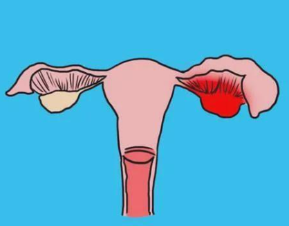 卵巢扭转会导致腹痛