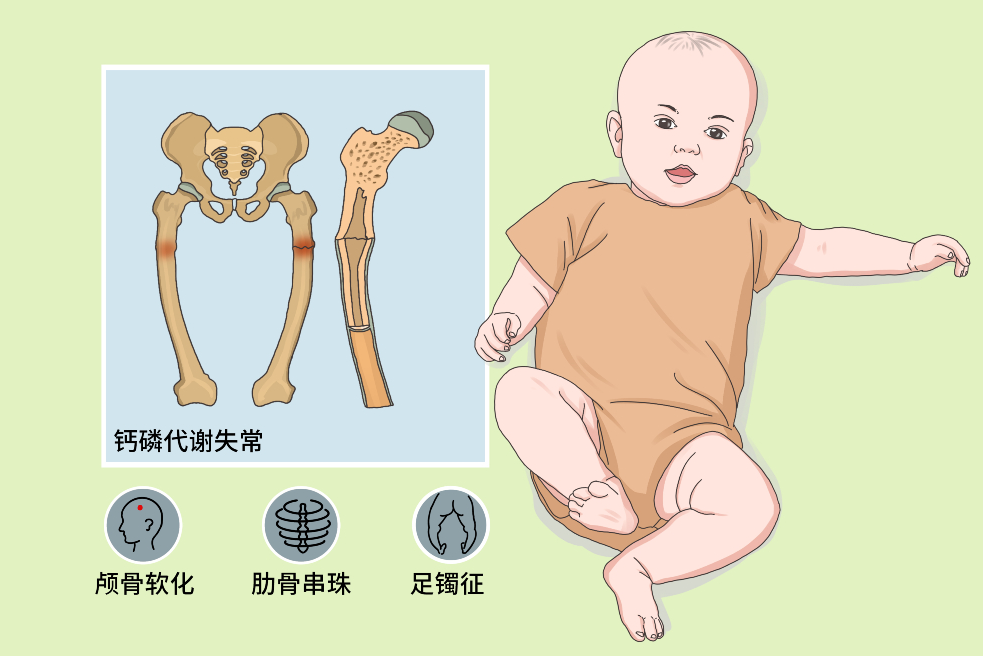 先天性软骨病是不是遗传病？造成软骨病的原因是什么?